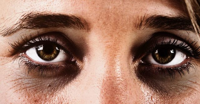 علت تیرگی زیر چشم چیست؟ بررسی جامع دلایل، پیشگیری و روشهای درمان