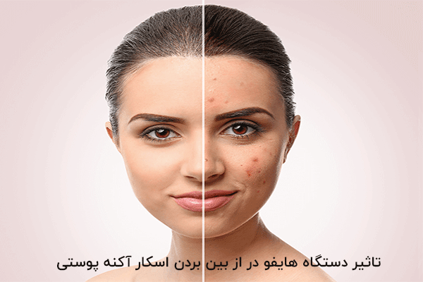 جای جوش و اسکار آکنه؛ انواع، علت‌ها و روش‌های علمی درمان و بازسازی پوست