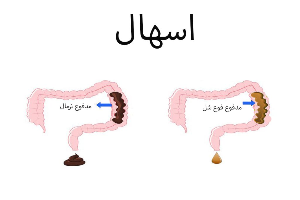 اسهال چیست؟ علائم، علت‌ها، عوارض و روش‌های درمان