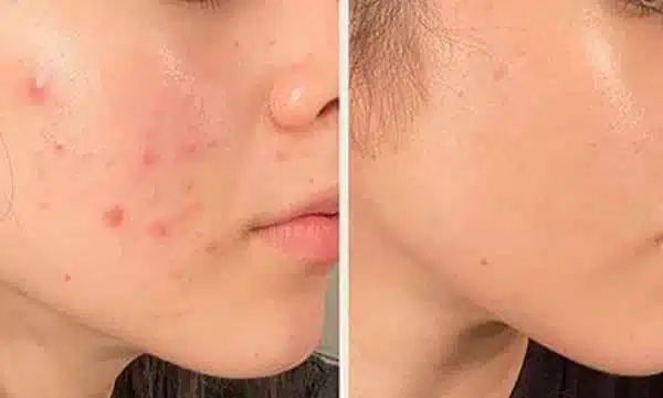 جوش صورت و آکنه؛ علتها، علائم و بهترین روشهای درمان و مراقبت