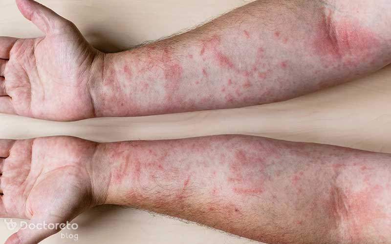 علت خارش پوست چیست؟ بررسی کامل علت‌ها، علائم و روش‌های درمان خارش پوست