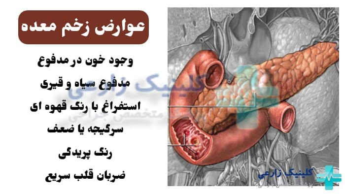 زخم معده چیست؟ علائم، علت‌ها، عوارض و روش‌های درمان