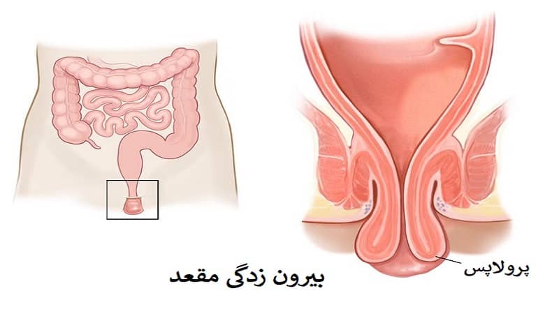 بواسیر چیست؟ علائم، علت‌ها، انواع و روش‌های درمان