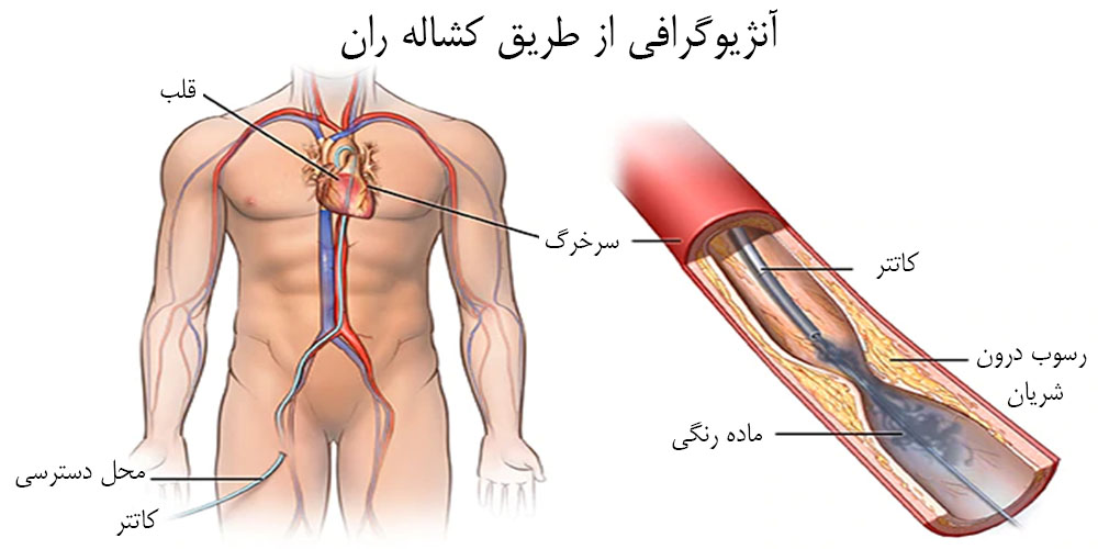 آنژیوپلاستی چیست؟ روش انجام، کاربردها، مزایا، عوارض و مراقبت‌ها