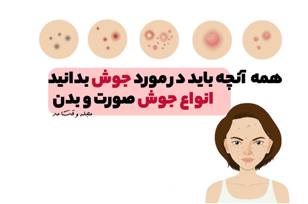 جوش صورت و آکنه؛ علتها، علائم و بهترین روشهای درمان و مراقبت