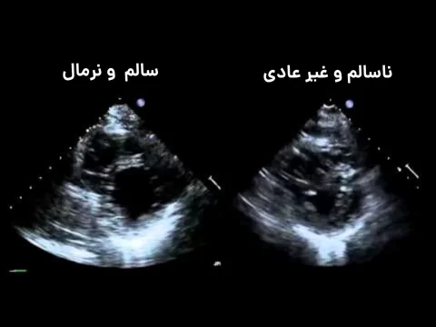 اکوکاردیوگرافی چیست؟ انواع اکو قلب، کاربردها، نحوه انجام و تفسیر نتایج