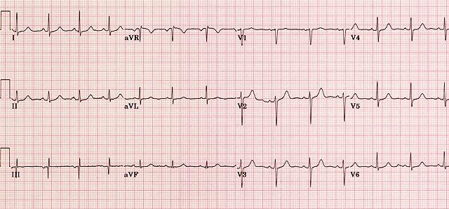 نوار قلب (ECG) چیست و چه بیماری‌هایی را نشان می‌دهد؟ با روش انجام، تفسیر ساده موج‌های نوار قلب و تفاوت آن با تست ورزش آشنا شوید.