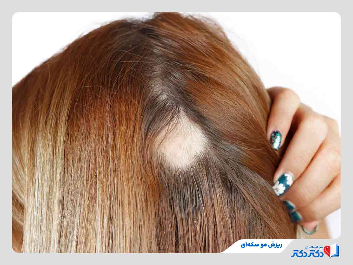 آلوپسی آره‌آتا چیست؟ علائم، علت‌ها و روش‌های درمان ریزش موی سکه‌ای