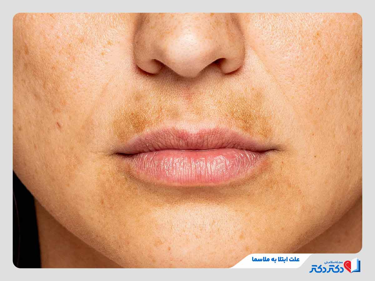 ملاسما یا لک بارداری چیست؟ علل، عوامل تشدیدکننده و درمان