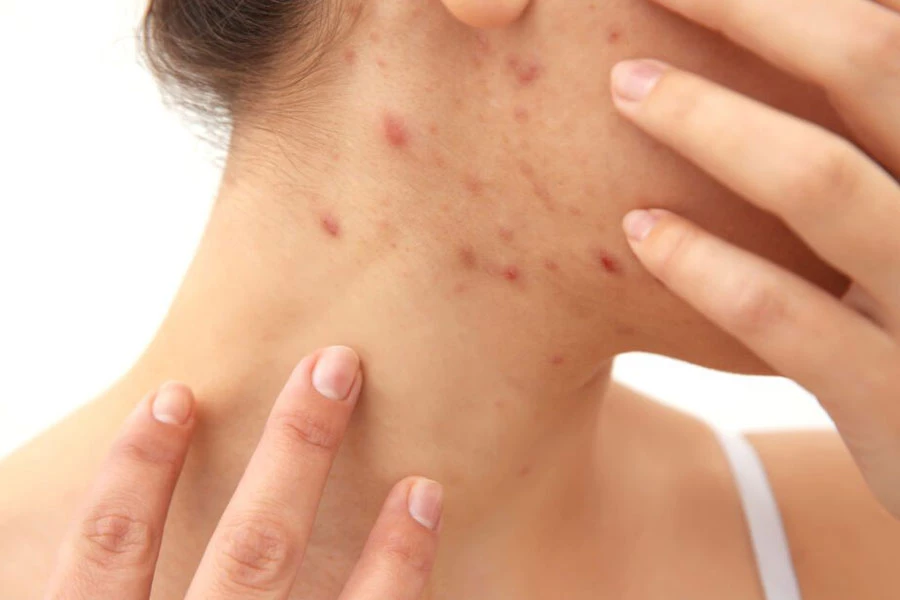 تأثیر هورمون‌ها بر آکنه، چربی پوست و ریزش مو؛ بررسی علمی و کاربردی