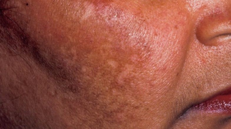 ملاسما یا لک بارداری چیست؟ علل، عوامل تشدیدکننده و درمان