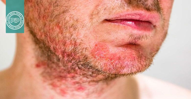شوره سر و درماتیت سبورئیک؛ علل، علائم و روشهای کنترل