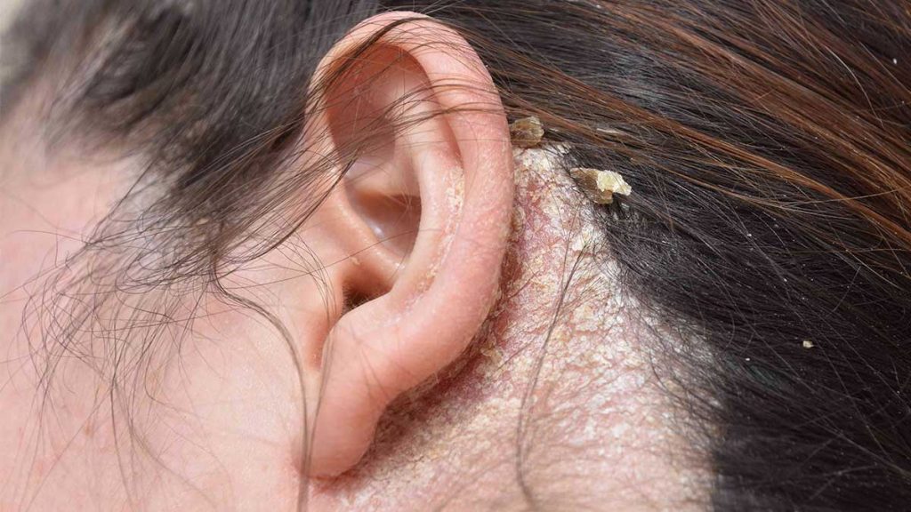 شوره سر و درماتیت سبورئیک؛ علل، علائم و روشهای کنترل
