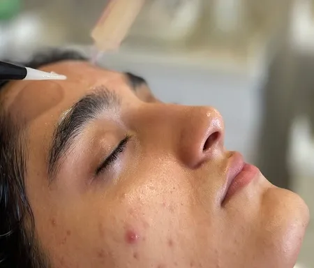 تأثیر هورمون‌ها بر آکنه، چربی پوست و ریزش مو؛ بررسی علمی و کاربردی