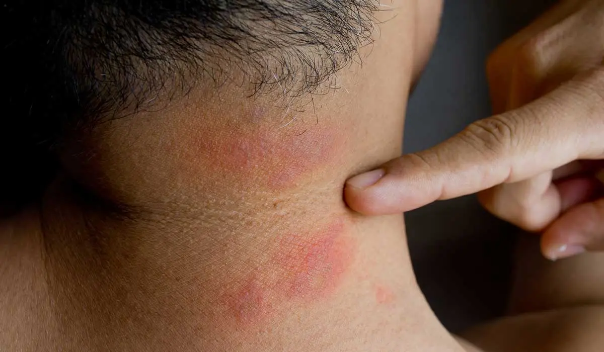 علت خارش پوست چیست؟ بررسی کامل علتها، علائم و روشهای درمان خارش پوست
