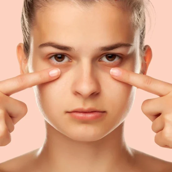 علت تیرگی زیر چشم چیست؟ بررسی جامع دلایل، پیشگیری و روش‌های درمان