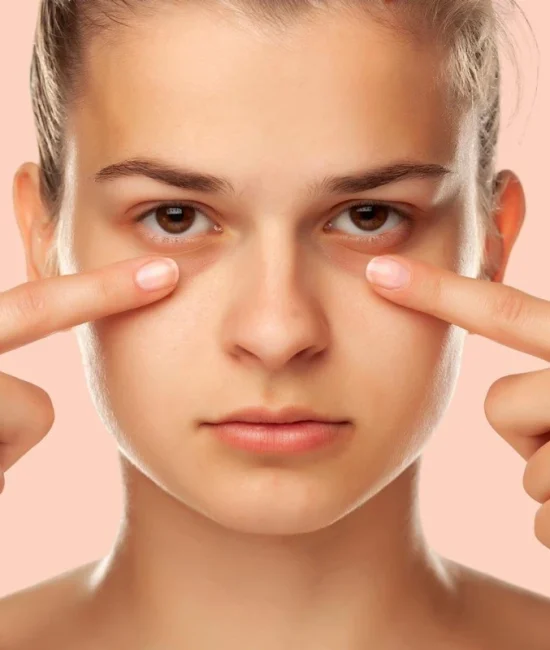 علت تیرگی زیر چشم چیست؟ بررسی جامع دلایل، پیشگیری و روش‌های درمان