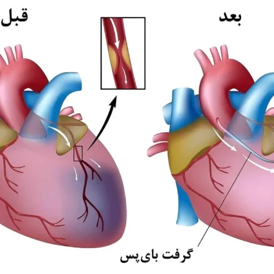 علائم حمله قلبی چیست؟ نشانه‌های سکته قلبی در مردان و زنان