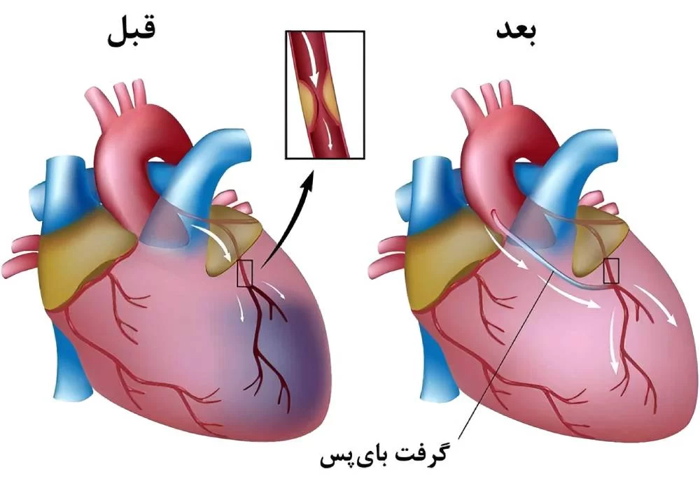علائم حمله قلبی چیست؟ نشانه‌های سکته قلبی در مردان و زنان
