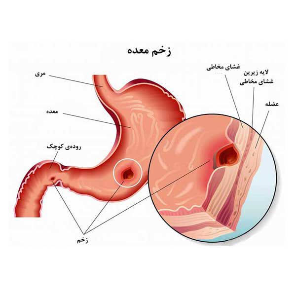 زخم معده چیست؟ علائم، علت‌ها، عوارض و روش‌های درمان