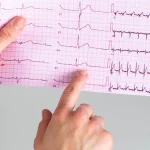 نوار قلب چیست؟ تفسیر ساده، علت انجام و بیماری‌های قابل تشخیص با ECG