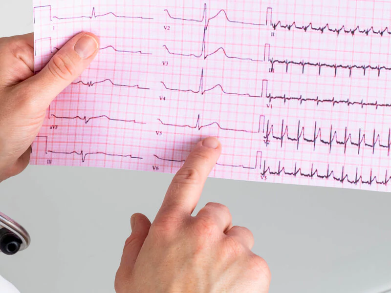 نوار قلب چیست؟ تفسیر ساده، علت انجام و بیماری‌های قابل تشخیص با ECG