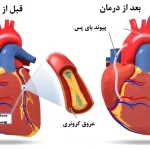 گرفتگی عروق قلب چیست؟ علائم، علت‌ها، تشخیص و روش‌های درمان