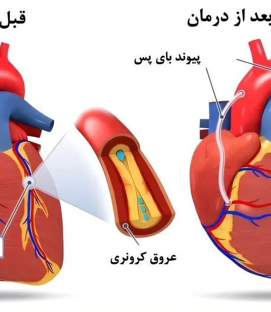 گرفتگی عروق قلب چیست؟ علائم، علت‌ها، تشخیص و روش‌های درمان