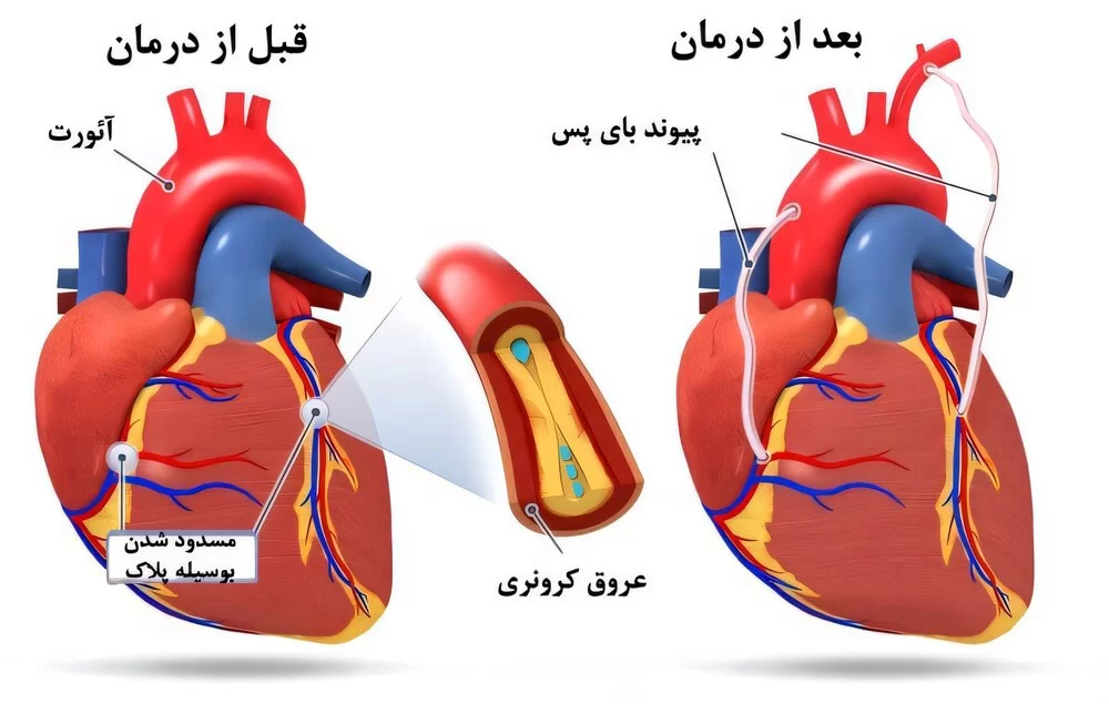 گرفتگی عروق قلب چیست؟ علائم، علت‌ها، تشخیص و روش‌های درمان