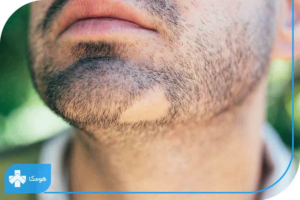 آلوپسی آرهآتا چیست؟ علائم، علتها و روشهای درمان ریزش موی سکهای