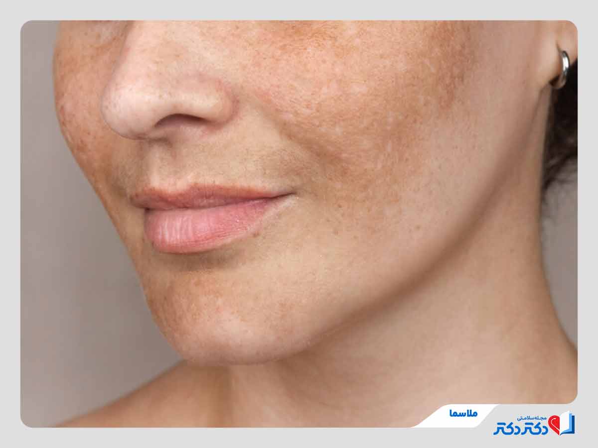 ملاسما یا لک بارداری چیست؟ علل، عوامل تشدیدکننده و درمان