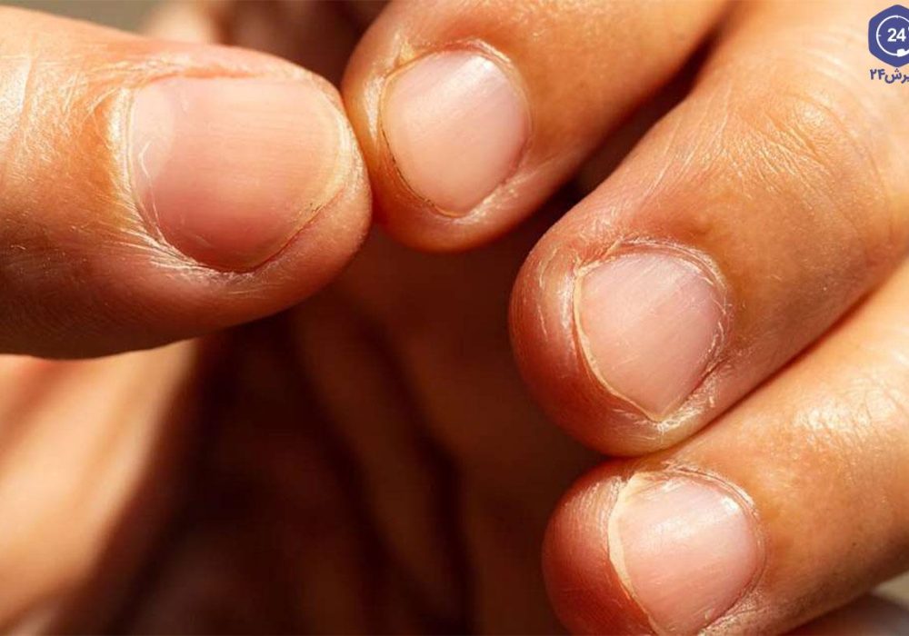 ناخن شکننده و لایه‌لایه شدن ناخن؛ علت‌ها، مراقبت و زمان مراجعه به پزشک