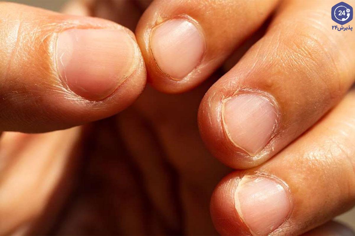 ناخن شکننده و لایه‌لایه شدن ناخن؛ علت‌ها، مراقبت و زمان مراجعه به پزشک