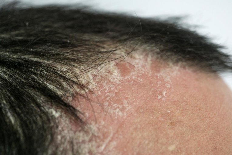 شوره سر و درماتیت سبورئیک؛ علل، علائم و روشهای کنترل