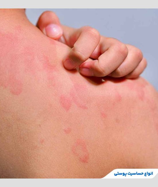 درماتیت تماسی چیست؟ تفاوت نوع تحریکی و آلرژیک، علائم، علل و درمان