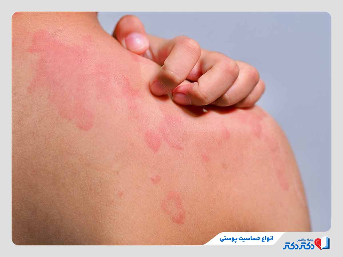 درماتیت تماسی چیست؟ تفاوت نوع تحریکی و آلرژیک، علائم، علل و درمان