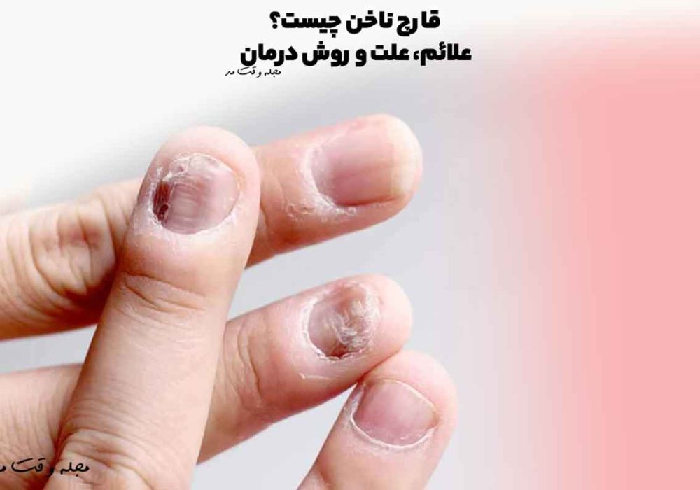 عفونت قارچی ناخن چیست و چه فرقی با تغییر رنگ ساده ناخن دارد؟