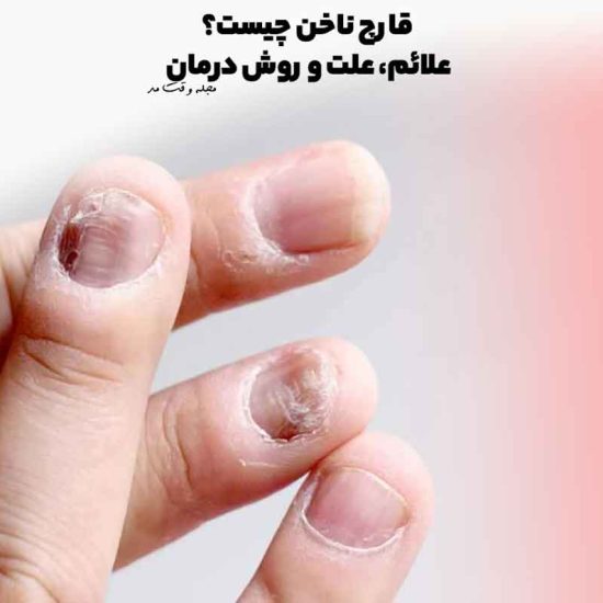 عفونت قارچی ناخن چیست و چه فرقی با تغییر رنگ ساده ناخن دارد؟