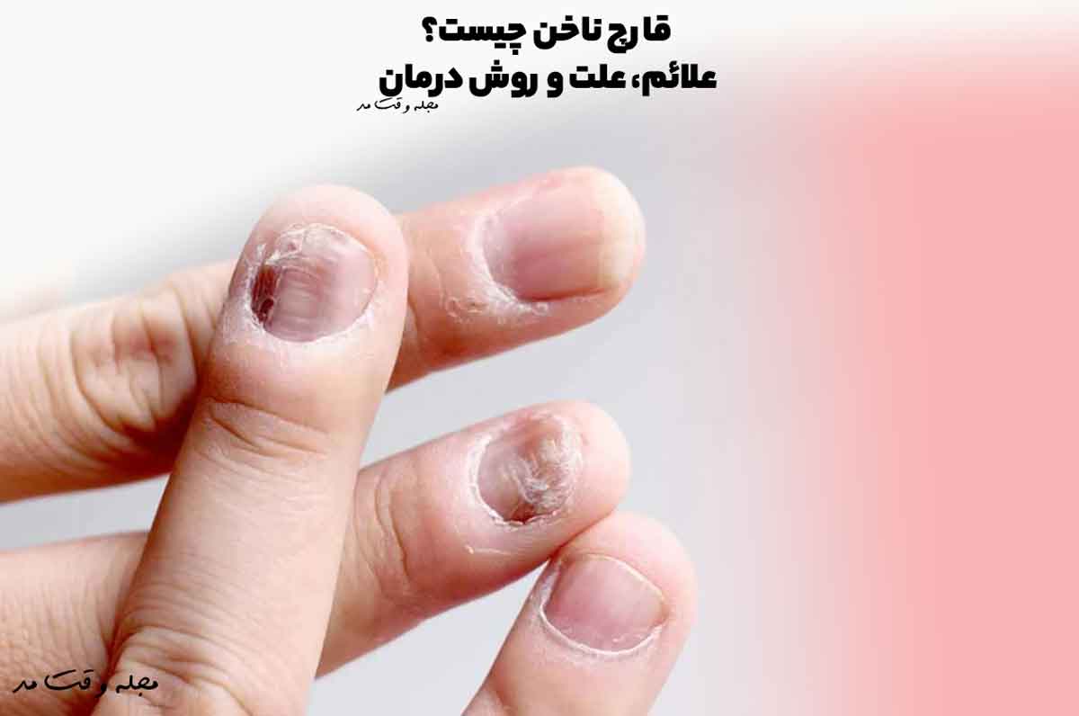 عفونت قارچی ناخن چیست و چه فرقی با تغییر رنگ ساده ناخن دارد؟
