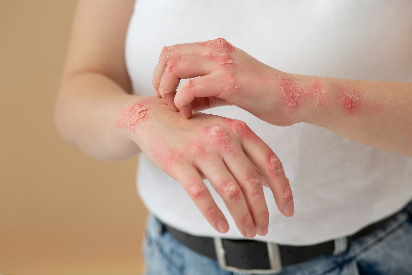 اگزما چیست؟ علائم، علتها، انواع و روشهای علمی درمان و کنترل اگزما