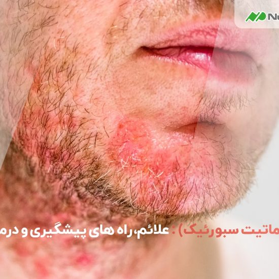 درماتیت سبورئیک چیست؟ بررسی کامل علائم، علت‌ها و روش‌های درمان درماتیت سبورئیک