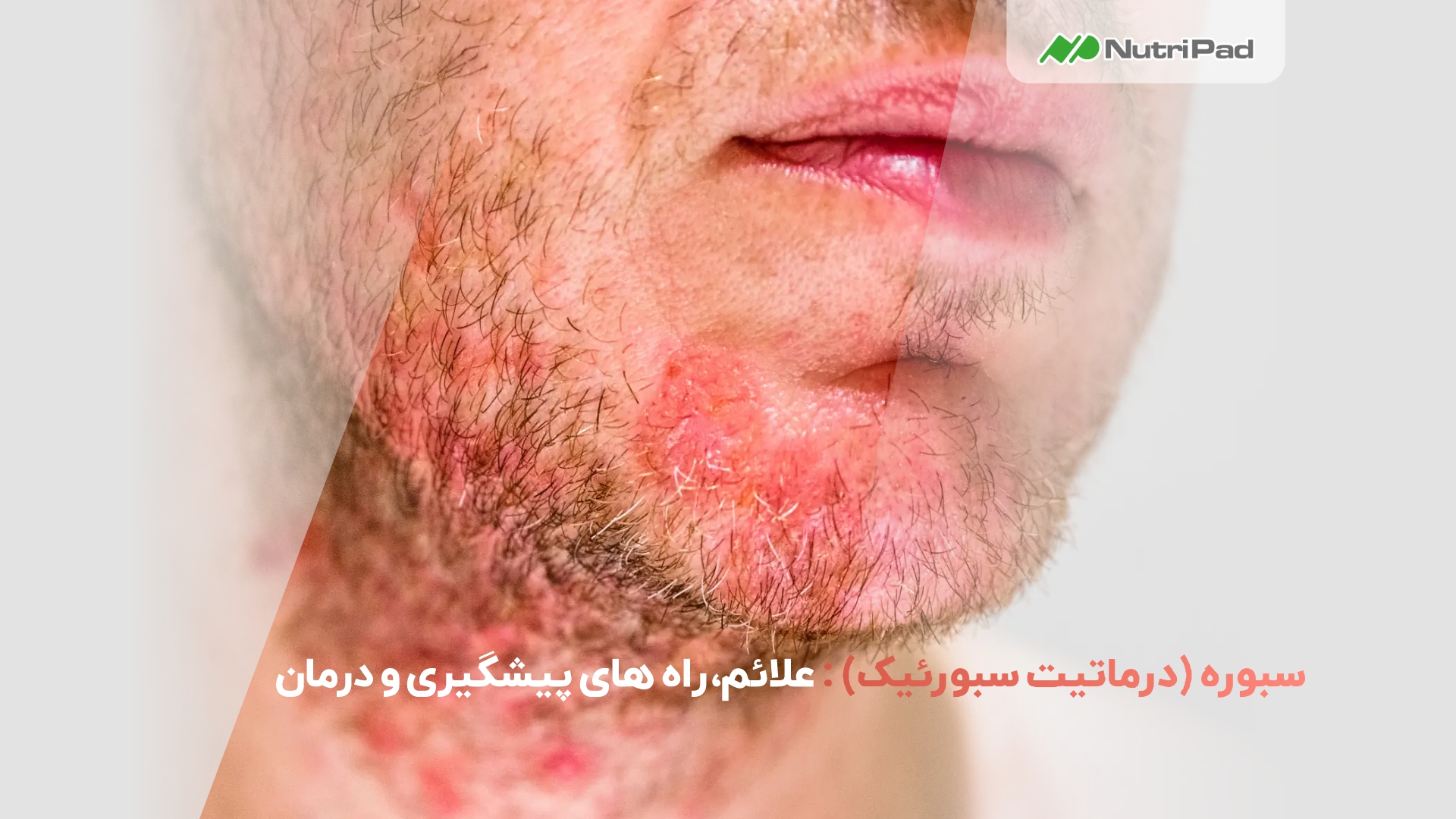 درماتیت سبورئیک چیست؟ بررسی کامل علائم، علتها و روشهای درمان درماتیت سبورئیک