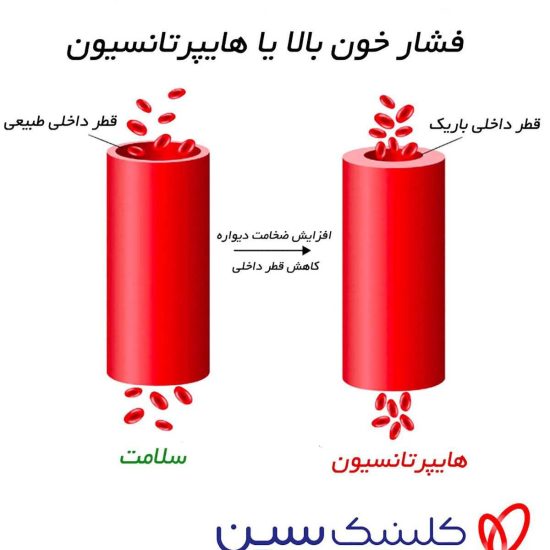 فشار خون بالا چیست؟ علائم، علل، تشخیص، عوارض و درمان قطعی کنترل آن