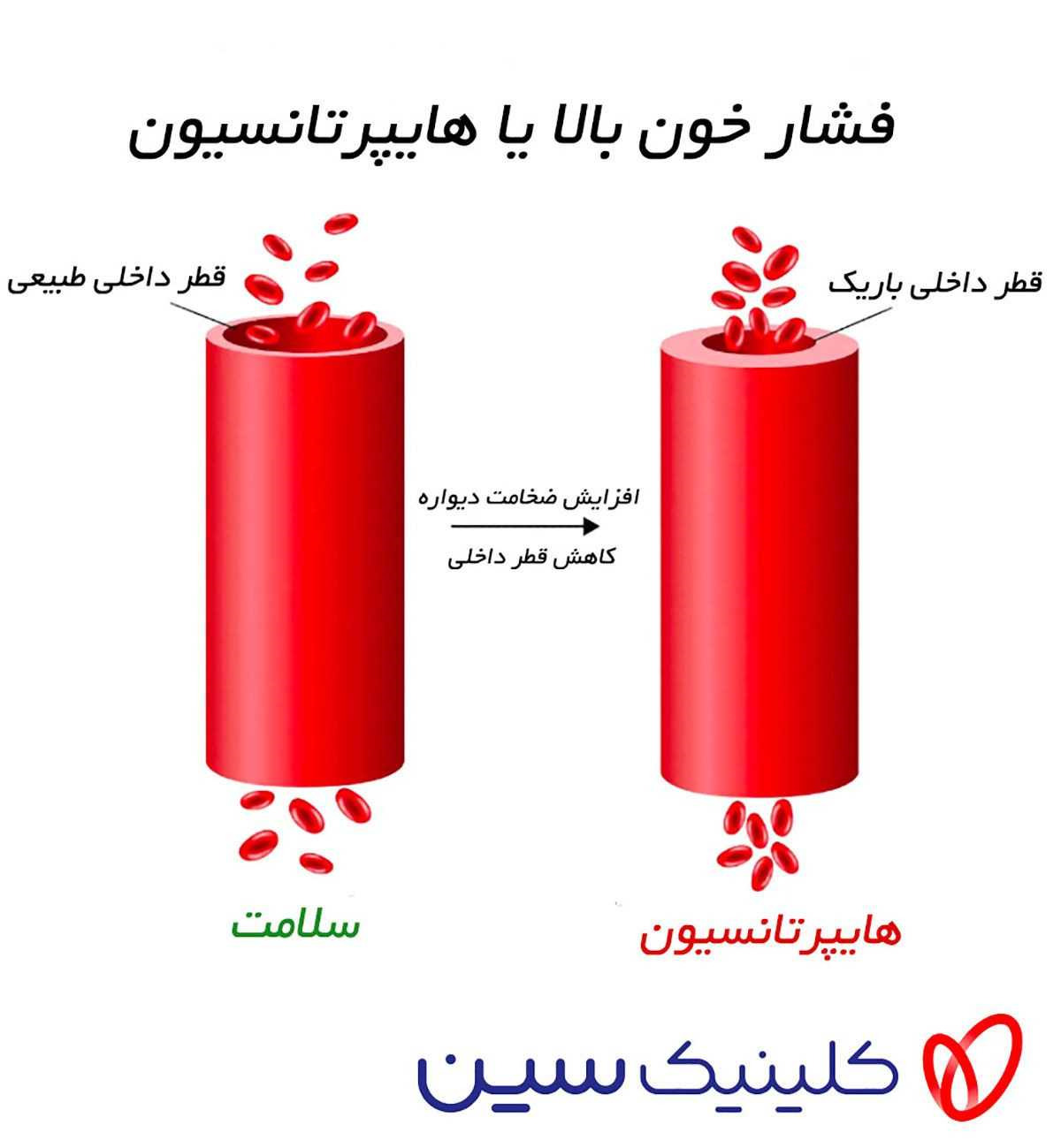 فشار خون بالا چیست؟ علائم، علل، تشخیص، عوارض و درمان قطعی کنترل آن