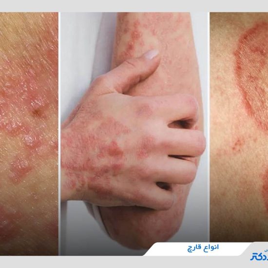 قارچ پوستی چیست؟ علت، علائم، انواع و روش‌های درمان قارچ پوست
